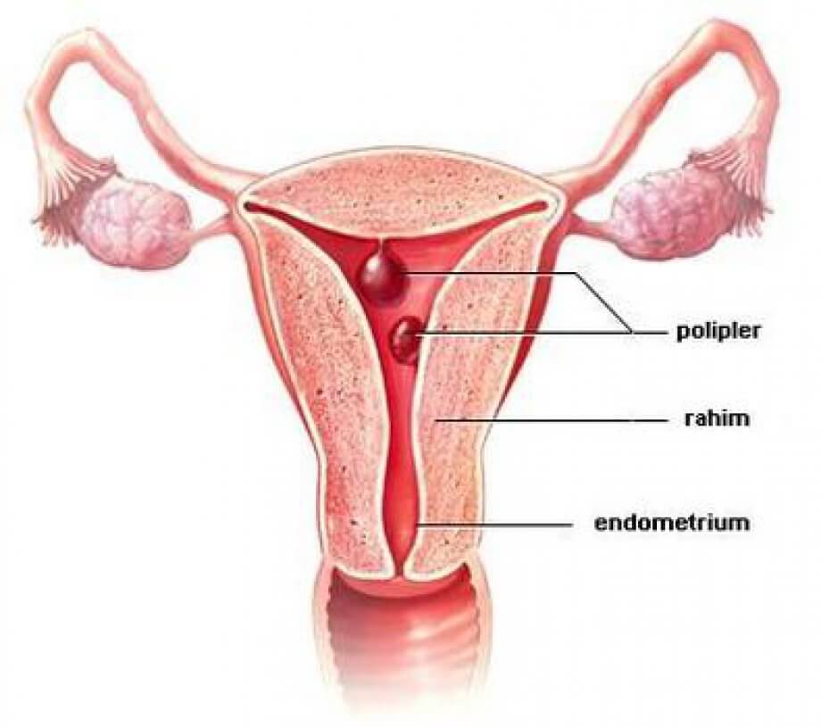 Endometrial Polipler