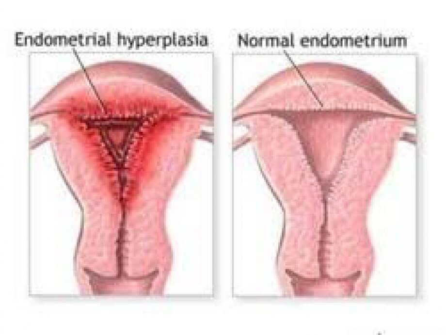 Endometrial Hiperplazi