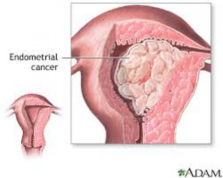 Endometrial Kanser