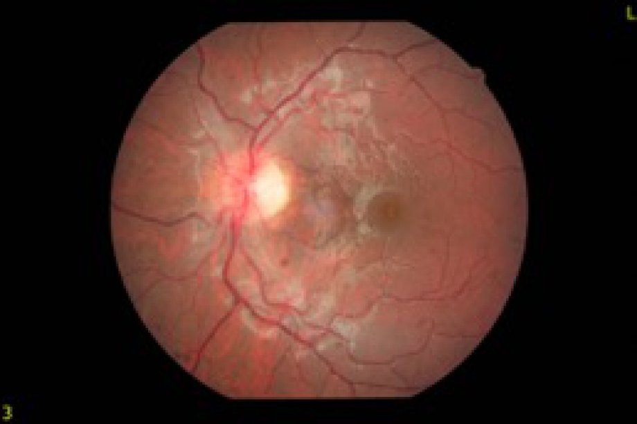 ''Leber’in Herediter Optik Nöropatisi-LHON'': Tanı ve tedavide yenilikler Başlığı ile LHON