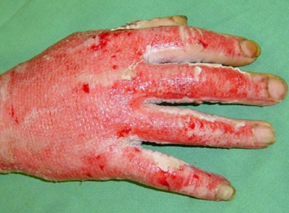 Application of Suprathel on Burns