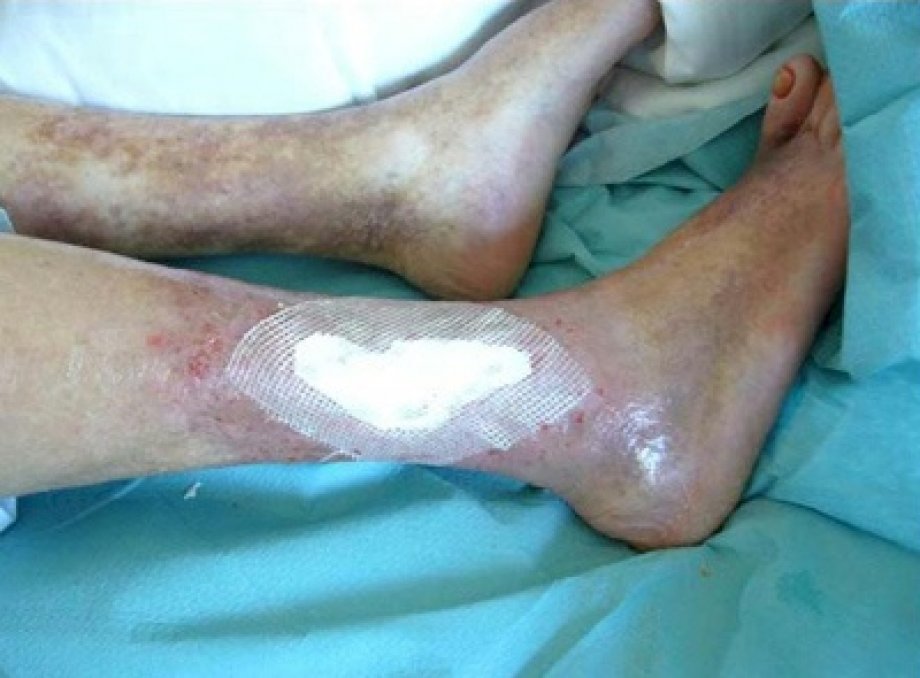 Application of Suprathel on Wounds